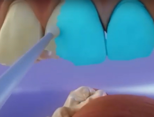 How is a veneer applied to your teeth to improve your smile?